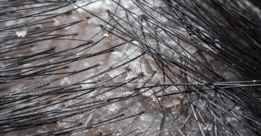 Relationship between Dandruff and Hair Loss