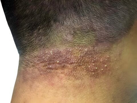 Is Seborrheic Dermatitis the Same as Dandruff?