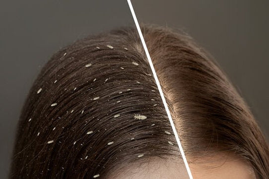 Is it Lice or Dandruff? How to Know Quickly