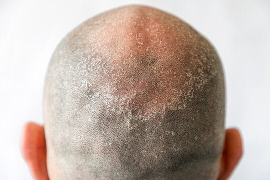 You Can Be Bald and Still Have Dandruff?! Yes - Here's How