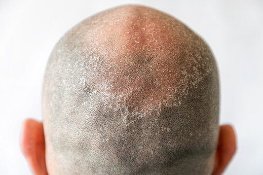 You Can Be Bald and Still Have Dandruff?! Yes - Here's How