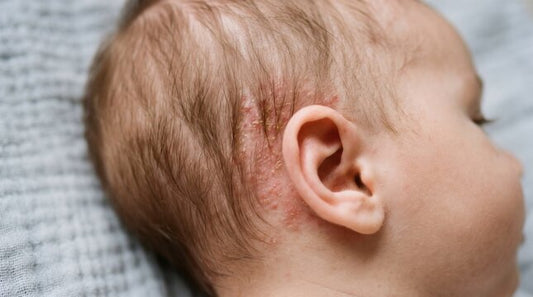 How to Spot Cradle Cap in Infants