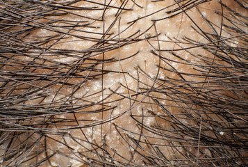 Dandruff vs Dry Scalp