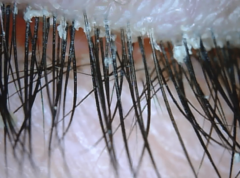 Eyelash Dandruff: What It Is and How to Get Rid of It