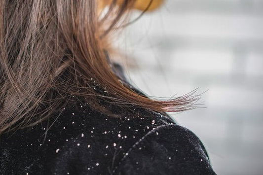 Why It's Normal To Have Dandruff