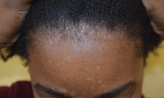 What is Petaloid Seborrheic Dermatitis? A Physician Answers