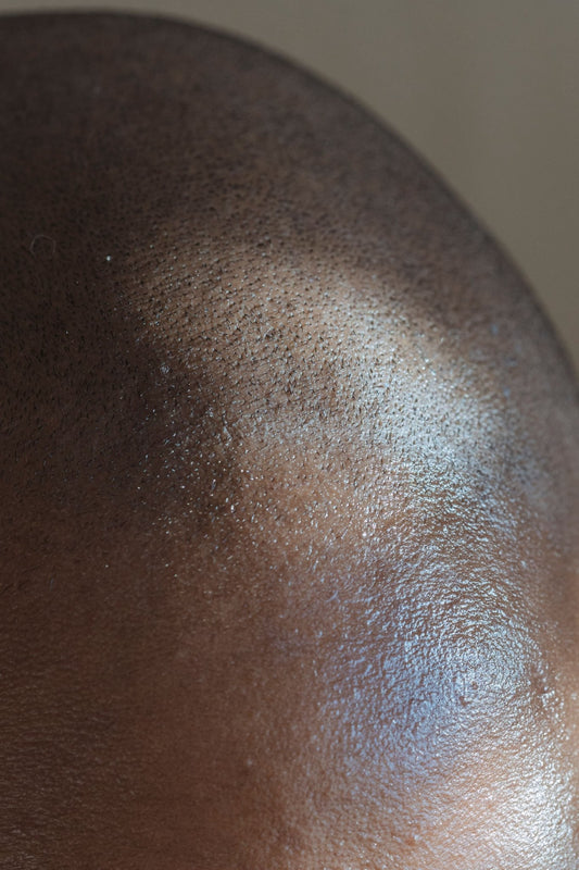 Scalp Psoriasis vs Seborrheic Dermatitis - A Physician Explains The Difference