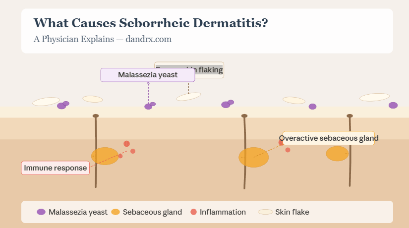 What causes Seborrheic Dermatitis? A Physician Explains