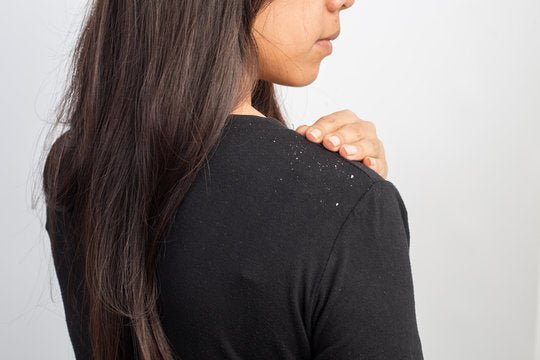 What Makes Dandruff Worse and What You Should NOT Do