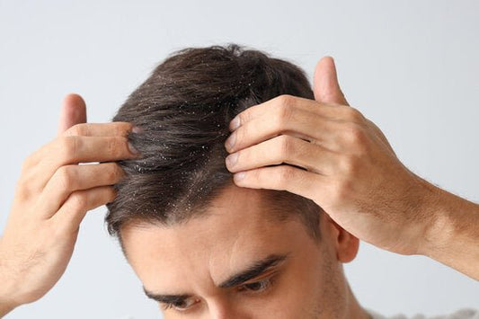 How To Prevent Dandruff Explained By a Physician