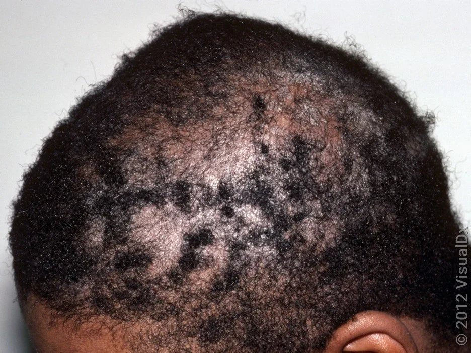 How Dandruff Looks On Different Skin Types