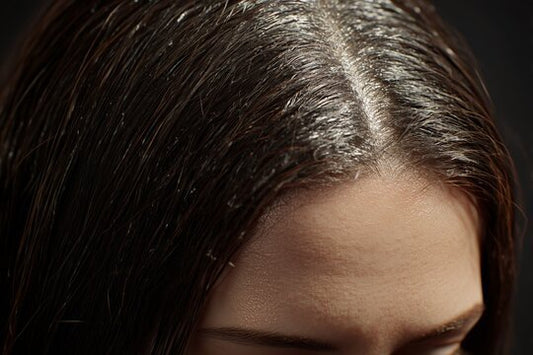 How To Diagnose and Treat Dandruff for Women
