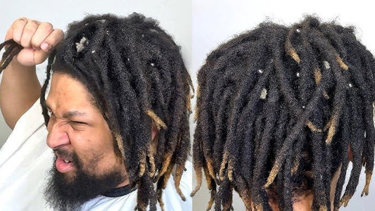How To Treat Dandruff on Dreadlocks - A Physician Explains